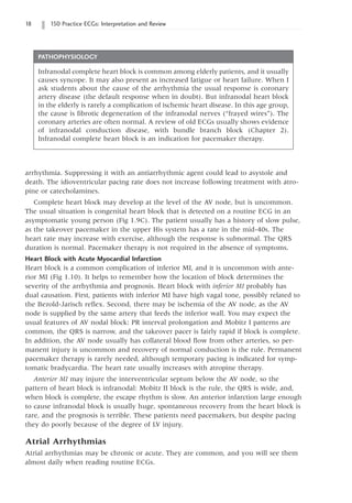 18 150 Practice ECGs: Interpretation and Review
arrhythmia. Suppressing it with an antiarrhythmic agent could lead to asystole and
death. The idioventricular pacing rate does not increase following treatment with atro-
pine or catecholamines.
Complete heart block may develop at the level of the AV node, but is uncommon.
The usual situation is congenital heart block that is detected on a routine ECG in an
asymptomatic young person (Fig 1.9C). The patient usually has a history of slow pulse,
as the takeover pacemaker in the upper His system has a rate in the mid-40s. The
heart rate may increase with exercise, although the response is subnormal. The QRS
duration is normal. Pacemaker therapy is not required in the absence of symptoms.
Heart Block with Acute Myocardial Infarction
Heart block is a common complication of inferior MI, and it is uncommon with ante-
rior MI (Fig 1.10). It helps to remember how the location of block determines the
severity of the arrhythmia and prognosis. Heart block with inferior MI probably has
dual causation. First, patients with inferior MI have high vagal tone, possibly related to
the Bezold-Jarisch reflex. Second, there may be ischemia of the AV node, as the AV
node is supplied by the same artery that feeds the inferior wall. You may expect the
usual features of AV nodal block: PR interval prolongation and Mobitz I patterns are
common, the QRS is narrow, and the takeover pacer is fairly rapid if block is complete.
In addition, the AV node usually has collateral blood flow from other arteries, so per-
manent injury is uncommon and recovery of normal conduction is the rule. Permanent
pacemaker therapy is rarely needed, although temporary pacing is indicated for symp-
tomatic bradycardia. The heart rate usually increases with atropine therapy.
Anterior MI may injure the interventricular septum below the AV node, so the
pattern of heart block is infranodal: Mobitz II block is the rule, the QRS is wide, and,
when block is complete, the escape rhythm is slow. An anterior infarction large enough
to cause infranodal block is usually huge, spontaneous recovery from the heart block is
rare, and the prognosis is terrible. These patients need pacemakers, but despite pacing
they do poorly because of the degree of LV injury.
Atrial Arrhythmias
Atrial arrhythmias may be chronic or acute. They are common, and you will see them
almost daily when reading routine ECGs.
PATHOPHYSIOLOGY
Infranodal complete heart block is common among elderly patients, and it usually
causes syncope. It may also present as increased fatigue or heart failure. When I
ask students about the cause of the arrhythmia the usual response is coronary
artery disease (the default response when in doubt). But infranodal heart block
in the elderly is rarely a complication of ischemic heart disease. In this age group,
the cause is fibrotic degeneration of the infranodal nerves (“frayed wires”). The
coronary arteries are often normal. A review of old ECGs usually shows evidence
of infranodal conduction disease, with bundle branch block (Chapter 2).
Infranodal complete heart block is an indication for pacemaker therapy.
 