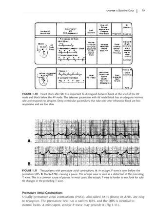 chapter 1: Baseline Data 19
FIGURE 1.10 Heart block after MI. It is important to distinguish between block at the level of the AV
node and block below the AV node. The takeover pacemaker with AV nodal block has an adequate intrinsic
rate and responds to atropine. Deep ventricular pacemakers that take over after infranodal block are less
responsive and are too slow.
FIGURE 1.1
1 Two patients with premature atrial contractions. A: An ectopic P wave is seen before the
premature QRS. B: Blocked PAC, causing a pause. The ectopic wave is seen as a distortion of the preceding
T wave. This is a common cause of pauses. In most cases, the ectopic P wave is harder to see; look for sub-
tle changes in the preceding T wave.
Premature Atrial Contractions
Usually premature atrial contractions (PACs), also called PABs (beats) or APBs, are easy
to recognize. The premature beat has a narrow QRS, and the QRS is identical to
normal beats. A misshapen, ectopic P wave may precede it (Fig 1.11).
 