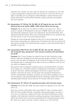 248 150 Practice ECGs: Interpretation and Review
and listen for a friction rub. Also, find an old ECG for comparison in case this
is early repolarization (though it does not look like it to me—the STs are too
high). If possible, get an emergency echocardiogram—normal anterior and
lateral wall motion would exclude ischemia (acutely ischemic myocardium
does not contract).
132. Interpretation: ST 1
10/min. PR .20, QRS .16, QT long for the rate. Axis 120°.
Abnormal due to the rhythm, RBBB + LPFB, anterior MI of uncertain age.
Comment: The P waves are not obvious: I believe I see them in V1. This is
another example of MI diagnosis in the face of RBBB. Before the anatomy of
the infranodal conduction system was understood, the fascicular blocks were
called peri-infarction block. Most cases of fascicular block are not caused by MI,
but this may be a case of true peri-infarction block.
Perhaps the worst prognostic finding on this ECG is sinus tachycardia. Recall
that resting tachycardia may indicate poor LV function after MI. An anterior MI
that injures enough of the interventricular septum to cause bifascicular block is
probably a large one.
133. Interpretation: NSR 75/min. PR .16, QRS .09, QTc .60. Axis 60°. Abnormal
due to long QT, deep, symmetrical T wave inversion consistent with anterolateral;
non-Q MI.
Comment: The T wave changes are typical of non-Q wave infarction. Some
patients with these findings do not have elevated cardiac enzymes. For this
reason, I do not make the diagnosis of MI on the ECG report, but leave that to
the clinician who is evaluating all the data. Q waves are different: with Qs you
can make the diagnosis of MI.
This patient with neurological symptoms had an intracranial bleed, and these
ECG changes are a relatively common complication of that illness. In addition
to deep T inversion, marked prolongation of the QT is typical. The ECG
changes come from the heart, not the head. The presumed mechanism is
massive catecholamine discharge caused by the acute bleed, leading to severe
vasoconstriction, and subendocardial ischemia. Pathologic studies have shown
subendocardial myolysis and an absence of coronary obstructive disease.
134. Interpretation: ST, 1
10/min. AV sequential pacemaker with ventricular pacing.
Comment: This looks like LBBB. But pacer spikes are apparent in II, aVF, aVR,
and V4–V6.
How can you have tachycardia with a pacemaker? Is this a runaway pacer?
With VVI units (single chamber, ventricular sensing and pacing), the pacer is
set to fire at a fixed rate, usually 70–75/min. But with the DDD pacer (dual
chamber, with atrial and ventricular sensing and pacing), the pacemaker will
follow the atrium’s lead, and sinus tachycardia with ventricular pacing is possi-
ble. There is an upper rate limit, which is usually set at 120–130/min.
 