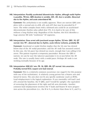 252 150 Practice ECGs: Interpretation and Review
148. Interpretation: Possibly accelerated idioventricular rhythm, although nodal rhythm
is possible, 70/min. QRS duration is variable, QTc .48. Axis is variable. Abnormal
due to the rhythm, and acute anterolateral MI.
Comment: The arrhythmia is not readily apparent. There are narrow QRS com-
plexs with a normal axis in aVR, aVL and aVF that may be preceded by P
wave. The wider complex beats with a leftward axis could be an accelerated
idioventricular rhythm (also called slow VT). It is hard to be sure of this
without a long rhythm strip. Regardless of the rhythm, this ECG identifies a
huge anterior MI with “tombstone” ST segments.
149. Interpretation: Sinus arrest with junctional escape rhythm, 32/min. QRS .10, QT
normal. Axis 70°, abnormal due to rhythm, acute inferior ischemia, probably MI.
Comment: Junctional or nodal rhythm implies that the SA rate has slowed
below that of the AV nodal pacemaker, and the AV node has assumed control.
In this case, the SA pacer has slowed too much, enough that I am calling it SA
arrest. This patient required a temporary pacemaker. Because the QRS is
narrow, we can be sure the takeover pacemaker is in or just below the AV
node. The rate is usually faster with a nodal pacer. Perhaps AV node is not
working normally because of its age.
150. Interpretation: NSR 65/ min. PR .16, QRS .08, QT normal. Axis uncertain.
Probably normal ECG; suspect arm lead reversal.
Comment: This is a relatively common occurrence (we staged it for this purpose
with one of the technicians). A relatively young person has a bizarre axis and
lateral Q waves. The axis does not fit any specific syndrome (such as RVH).
Lead misplacement is the logical explanation. If you (mentally) roll lead I and
aVL around the baseline, the P, QRS, and T would be upright—the equivalent
of correcting the placement of the right and left arm electrodes. Another
common lead misplacement involves the V leads and bizarre R wave progres-
sion across the precordium (i.e., the R in V4 is shorter than those in V2 and V3).
 