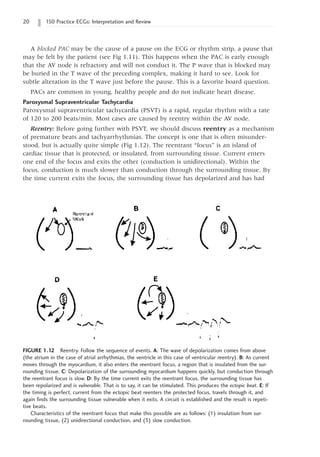 20 150 Practice ECGs: Interpretation and Review
A blocked PAC may be the cause of a pause on the ECG or rhythm strip, a pause that
may be felt by the patient (see Fig 1.11). This happens when the PAC is early enough
that the AV node is refractory and will not conduct it. The P wave that is blocked may
be buried in the T wave of the preceding complex, making it hard to see. Look for
subtle alteration in the T wave just before the pause. This is a favorite board question.
PACs are common in young, healthy people and do not indicate heart disease.
Paroxysmal Supraventricular Tachycardia
Paroxysmal supraventricular tachycardia (PSVT) is a rapid, regular rhythm with a rate
of 120 to 200 beats/min. Most cases are caused by reentry within the AV node.
Reentry: Before going further with PSVT, we should discuss reentry as a mechanism
of premature beats and tachyarrhythmias. The concept is one that is often misunder-
stood, but is actually quite simple (Fig 1.12). The reentrant “focus” is an island of
cardiac tissue that is protected, or insulated, from surrounding tissue. Current enters
one end of the focus and exits the other (conduction is unidirectional). Within the
focus, conduction is much slower than conduction through the surrounding tissue. By
the time current exits the focus, the surrounding tissue has depolarized and has had
FIGURE 1.12 Reentry. Follow the sequence of events. A: The wave of depolarization comes from above
(the atrium in the case of atrial arrhythmias, the ventricle in this case of ventricular reentry). B: As current
moves through the myocardium, it also enters the reentrant focus, a region that is insulated from the sur-
rounding tissue. C: Depolarization of the surrounding myocardium happens quickly, but conduction through
the reentrant focus is slow. D: By the time current exits the reentrant focus, the surrounding tissue has
been repolarized and is vulnerable. That is to say, it can be stimulated. This produces the ectopic beat. E: If
the timing is perfect, current from the ectopic beat reenters the protected focus, travels through it, and
again finds the surrounding tissue vulnerable when it exits. A circuit is established and the result is repeti-
tive beats.
Characteristics of the reentrant focus that make this possible are as follows: (1) insulation from sur-
rounding tissue, (2) unidirectional conduction, and (3) slow conduction.
 