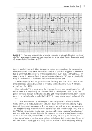 chapter 1: Baseline Data 21
time to repolarize as well. Thus, the current exiting the focus finds the surrounding
tissue vulnerable, ready to be stimulated, and that is just what happens: a premature
beat is generated. This seems to be the mechanism of many atrial and ventricular pre-
mature beats. A reentrant focus in the atrium would cause a PAC, and a focus in the
body of the ventricle, a premature ventricular contraction (PVC).
If the timing is perfect, the premature beat may slip back into the entrance of the
reentrant focus, leading to another or even to a series of ectopic beats. A circuit is
created (see Fig 1.12E).
Now back to PSVT. In most cases, the reentrant focus is near or within the body of
the AV node. Current exiting the reentrant focus is coming from the AV node and
passes normally through the His bundle. The QRS complex is therefore narrow (unless
there is coexisting bundle branch block). PSVT is thus a narrow complex tachycardia (Fig
1.13).
PSVT is a common and occasionally recurrent arrhythmia in otherwise healthy
young people. It is not dangerous or fatal, but it can be bothersome, causing palpita-
tions, dizziness, and near-syncope. It is uncommon for patients to lose consciousness.
The arrhythmia may be interrupted with maneuvers that increase vagal tone, such as
the Valsalva maneuver or carotid sinus massage. Adenosine blocks AV nodal conduc-
tion and is the treatment of choice in the emergency room. When symptoms are fre-
quent or are not easily controlled by medical therapy, ablation of the reentrant focus
within the AV node is possible using catheter techniques. This is a cure (we do not do
much of that in cardiology), and many patients prefer this to life-long drug therapy.
FIGURE 1.13 Paroxysmal supraventricular tachycardia, a recording of limb leads. The rate is 200 beats/
min. The T waves appear distorted, and these distortions may be the ectopic P waves. This episode lasted
45 minutes, plenty of time to get an ECG.
 
