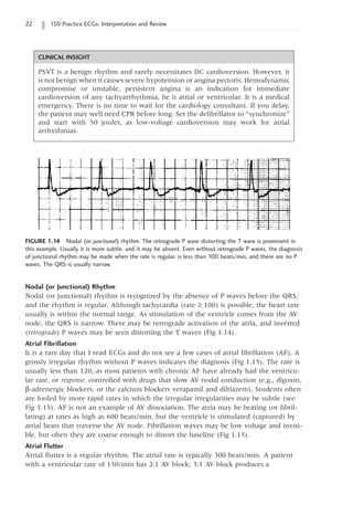 22 150 Practice ECGs: Interpretation and Review
FIGURE 1.14 Nodal (or junctional) rhythm. The retrograde P wave distorting the T wave is prominent in
this example. Usually it is more subtle, and it may be absent. Even without retrograde P waves, the diagnosis
of junctional rhythm may be made when the rate is regular, is less than 100 beats/min, and there are no P
waves. The QRS is usually narrow.
Nodal (or Junctional) Rhythm
Nodal (or junctional) rhythm is recognized by the absence of P waves before the QRS,
and the rhythm is regular. Although tachycardia (rate ≥ 100) is possible, the heart rate
usually is within the normal range. As stimulation of the ventricle comes from the AV
node, the QRS is narrow. There may be retrograde activation of the atria, and inverted
(retrograde) P waves may be seen distorting the T waves (Fig 1.14).
Atrial Fibrillation
It is a rare day that I read ECGs and do not see a few cases of atrial fibrillation (AF). A
grossly irregular rhythm without P waves indicates the diagnosis (Fig 1.15). The rate is
usually less than 120, as most patients with chronic AF have already had the ventricu-
lar rate, or response, controlled with drugs that slow AV nodal conduction (e.g., digoxin,
b-adrenergic blockers, or the calcium blockers verapamil and diltiazem). Students often
are fooled by more rapid rates in which the irregular irregularities may be subtle (see
Fig 1.15). AF is not an example of AV dissociation. The atria may be beating (or fibril-
lating) at rates as high as 600 beats/min, but the ventricle is stimulated (captured) by
atrial beats that traverse the AV node. Fibrillation waves may be low voltage and invisi-
ble, but often they are coarse enough to distort the baseline (Fig 1.15).
Atrial Flutter
Atrial flutter is a regular rhythm. The atrial rate is typically 300 beats/min. A patient
with a ventricular rate of 150/min has 2:1 AV block; 3:1 AV block produces a
CLINICAL INSIGHT
PSVT is a benign rhythm and rarely necessitates DC cardioversion. However, it
is not benign when it causes severe hypotension or angina pectoris. Hemodynamic
compromise or unstable, persistent angina is an indication for immediate
cardioversion of any tachyarrhythmia, be it atrial or ventricular. It is a medical
emergency. There is no time to wait for the cardiology consultant. If you delay,
the patient may well need CPR before long. Set the defibrillator to “synchronize”
and start with 50 joules, as low-voltage cardioversion may work for atrial
arrhythmias.
 