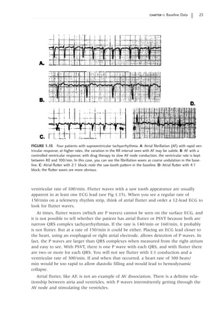 chapter 1: Baseline Data 23
ventricular rate of 100/min. Flutter waves with a saw tooth appearance are usually
apparent in at least one ECG lead (see Fig 1.15). When you see a regular rate of
150/min on a telemetry rhythm strip, think of atrial flutter and order a 12-lead ECG to
look for flutter waves.
At times, flutter waves (which are P waves) cannot be seen on the surface ECG, and
it is not possible to tell whether the patient has atrial flutter or PSVT because both are
narrow QRS complex tachyarrhythmias. If the rate is 140/min or 160/min, it probably
is not flutter. But at a rate of 150/min it could be either. Placing an ECG lead closer to
the heart, using an esophageal or right atrial electrode, allows detection of P waves. In
fact, the P waves are larger than QRS complexes when measured from the right atrium
and easy to see. With PSVT, there is one P wave with each QRS, and with flutter there
are two or more for each QRS. You will not see flutter with 1:1 conduction and a
ventricular rate of 300/min. If and when that occurred, a heart rate of 300 beats/
min would be too rapid to allow diastolic filling and would lead to hemodynamic
collapse.
Atrial flutter, like AF, is not an example of AV dissociation. There is a definite rela-
tionship between atria and ventricles, with P waves intermittently getting through the
AV node and stimulating the ventricles.
FIGURE 1.15 Four patients with supraventricular tachyarrhythmia. A: Atrial fibrillation (AF) with rapid ven-
tricular response; at higher rates, the variation in the RR interval seen with AF may be subtle. B: AF with a
controlled ventricular response; with drug therapy to slow AV node conduction, the ventricular rate is kept
between 80 and 100/min. In this case, you can see the fibrillation waves as coarse undulation in the base-
line. C: Atrial flutter with 2:1 block; note the saw-tooth pattern in the baseline. D: Atrial flutter with 4:1 
block; the flutter waves are more obvious.
 
