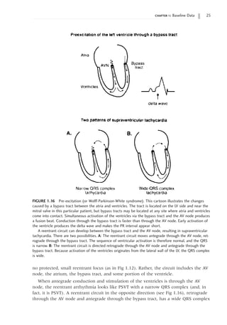 chapter 1: Baseline Data 25
no protected, small reentrant focus (as in Fig 1.12). Rather, the circuit includes the AV
node, the atrium, the bypass tract, and some portion of the ventricle.
When antegrade conduction and stimulation of the ventricles is through the AV
node, the reentrant arrhythmia looks like PSVT with a narrow QRS complex (and, in
fact, it is PSVT). A reentrant circuit in the opposite direction (see Fig 1.16), retrograde
through the AV node and antegrade through the bypass tract, has a wide QRS complex
FIGURE 1.16 Pre-excitation (or Wolff-Parkinson-White syndrome). This cartoon illustrates the changes
caused by a bypass tract between the atria and ventricles. The tract is located on the LV side and near the
mitral valve in this particular patient, but bypass tracts may be located at any site where atria and ventricles
come into contact. Simultaneous activation of the ventricles via the bypass tract and the AV node produces
a fusion beat. Conduction through the bypass tract is faster than through the AV node. Early activation of
the ventricle produces the delta wave and makes the PR interval appear short.
A reentrant circuit can develop between the bypass tract and the AV node, resulting in supraventricular
tachycardia. There are two possibilities. A: The reentrant circuit moves antegrade through the AV node, ret-
rograde through the bypass tract. The sequence of ventricular activation is therefore normal, and the QRS
is narrow. B: The reentrant circuit is directed retrograde through the AV node and antegrade through the
bypass tract. Because activation of the ventricles originates from the lateral wall of the LV, the QRS complex
is wide.
 