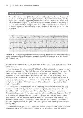 26 150 Practice ECGs: Interpretation and Review
because the sequence of ventricular activation is abnormal. It may look like ventricular
tachycardia (VT).
How can you tell whether this wide QRS tachycardia is ventricular or supraventricu-
lar? At times you cannot. The clinical setting helps. A young patient with a history of
PSVT, no other heart disease, wide-complex tachycardia, and no alteration of con-
sciousness is likely to have PSVT with bypass tract reentry. An older patient with a
history of heart failure or MI, and who has had syncope or near-syncope, should be
treated assuming a diagnosis of VT. When in doubt, it is hard to go wrong treating the
arrhythmia as probable VT. Direct current (DC) cardioversion is appropriate if the
patient is unstable.
It is important to identify PSVT that is caused by pre-excitation because the drug
treatment is different. Digoxin, beta blockers, verapamil, and intravenous adenosine
should be avoided because they slow AV nodal conduction, but not conduction
through the bypass tract. If the patient develops AF or atrial flutter, drugs that slow AV
node conduction favor conduction through the bypass tract. Bypass tracts conduct
more rapidly than the AV node, so there could be a big increase in ventricular rate.
Membrane-active agents, on the other hand, slow accessory pathway conduction;
intravenous procainamide is a good choice for a patient with WPW syndrome who is
having PSVT.
Procainamide has been used for long-term management of pre-excitation. A newer
and more effective therapy is catheter ablation of the bypass tract, and it is usually a
PATHOPHYSIOLOGY
Most of the time a wide QRS indicates infranodal conduction disease. As you will
see in the next chapter, initial depolarization of the ventricle is normal, and the
region of the ventricle supplied by the blocked nerve is activated late. Thus, with
left bundle branch block, the left side is depolarized late. The result is slurring of
the tail end of the QRS complex. The wide QRS of preexcitation is different. It
is the initial phase of depolarization that is affected, so the front end of the QRS
is slurred.
FIGURE 1.17 Pre-excitation (Wolff-Parkinson-White syndrome). The PR interval is short, and the QRS is
slightly widened. Slurring of the upstroke of the QRS is apparent in multiple leads (I, aVL, the V leads);
this is the delta wave.
 