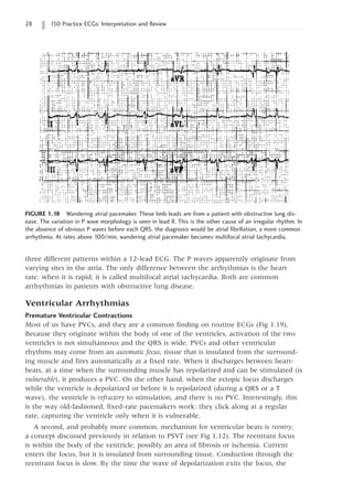 28 150 Practice ECGs: Interpretation and Review
three different patterns within a 12-lead ECG. The P waves apparently originate from
varying sites in the atria. The only difference between the arrhythmias is the heart
rate: when it is rapid, it is called multifocal atrial tachycardia. Both are common
arrhythmias in patients with obstructive lung disease.
Ventricular Arrhythmias
Premature Ventricular Contractions
Most of us have PVCs, and they are a common finding on routine ECGs (Fig 1.19).
Because they originate within the body of one of the ventricles, activation of the two
ventricles is not simultaneous and the QRS is wide. PVCs and other ventricular
rhythms may come from an automatic focus, tissue that is insulated from the surround-
ing muscle and fires automatically at a fixed rate. When it discharges between heart-
beats, at a time when the surrounding muscle has repolarized and can be stimulated (is
vulnerable), it produces a PVC. On the other hand, when the ectopic focus discharges
while the ventricle is depolarized or before it is repolarized (during a QRS or a T
wave), the ventricle is refractory to stimulation, and there is no PVC. Interestingly, this
is the way old-fashioned, fixed-rate pacemakers work: they click along at a regular
rate, capturing the ventricle only when it is vulnerable.
A second, and probably more common, mechanism for ventricular beats is reentry,
a concept discussed previously in relation to PSVT (see Fig 1.12). The reentrant focus
is within the body of the ventricle, possibly an area of fibrosis or ischemia. Current
enters the focus, but it is insulated from surrounding tissue. Conduction through the
reentrant focus is slow. By the time the wave of depolarization exits the focus, the
FIGURE 1.18 Wandering atrial pacemaker. These limb leads are from a patient with obstructive lung dis-
ease. The variation in P wave morphology is seen in lead II. This is the other cause of an irregular rhythm. In
the absence of obvious P waves before each QRS, the diagnosis would be atrial fibrillation, a more common
arrhythmia. At rates above 100/min, wandering atrial pacemaker becomes multifocal atrial tachycardia.
 