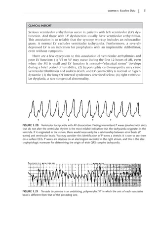 chapter 1: Baseline Data 31
CLINICAL INSIGHT
Serious ventricular arrhythmias occur in patients with left ventricular (LV) dys-
function. And those with LV dysfunction usually have ventricular arrhythmias.
This association is so reliable that the syncope workup includes an echocardio-
gram. A normal LV excludes ventricular tachycardia. Furthermore, a severely
depressed LV is an indication for prophylaxis with an implantable defibrillator,
even without symptoms.
There are a few exceptions to this association of ventricular arrhythmias and
poor LV function: (1) VT or VF may occur during the first 12 hours of MI, even
when the MI is small and LV function is normal—”electrical storm” develops
during a brief period of instability; (2) hypertrophic cardiomyopathy may cause
ventricular fibrillation and sudden death, and LV contractility is normal or hyper-
dynamic; (3) the long QT interval syndromes described below; (4) right ventricu-
lar dysplasia, a rare congenital abnormality.
FIGURE 1.20 Ventricular tachycardia with AV dissociation. Finding intermittent P waves (marked with dots)
that do not alter the ventricular rhythm is the most reliable indication that the tachycardia originates in the
ventricle. If it originated in the atrium, there would necessarily be a relationship between atrial beats (P
waves) and ventricular beats. You may consider this identification of P waves a stretch; it is rare to see them
on a surface ECG. P waves are obvious on an electrogram recorded in the right atrium, and this is the elec-
trophysiologic maneuver for determining the origin of wide QRS complex tachycardia.
FIGURE 1.21 Torsade de pointes is an undulating, polymorphic VT in which the axis of each successive
beat is different from that of the preceding one.
 