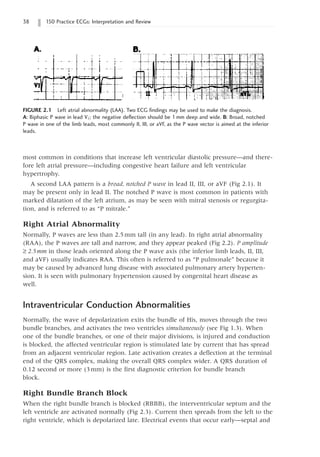 38 150 Practice ECGs: Interpretation and Review
most common in conditions that increase left ventricular diastolic pressure—and there-
fore left atrial pressure—including congestive heart failure and left ventricular
hypertrophy.
A second LAA pattern is a broad, notched P wave in lead II, III, or aVF (Fig 2.1). It
may be present only in lead II. The notched P wave is most common in patients with
marked dilatation of the left atrium, as may be seen with mitral stenosis or regurgita-
tion, and is referred to as “P mitrale.”
Right Atrial Abnormality
Normally, P waves are less than 2.5mm tall (in any lead). In right atrial abnormality
(RAA), the P waves are tall and narrow, and they appear peaked (Fig 2.2). P amplitude
≥ 2.5mm in those leads oriented along the P wave axis (the inferior limb leads, II, III,
and aVF) usually indicates RAA. This often is referred to as “P pulmonale” because it
may be caused by advanced lung disease with associated pulmonary artery hyperten-
sion. It is seen with pulmonary hypertension caused by congenital heart disease as
well.
Intraventricular Conduction Abnormalities
Normally, the wave of depolarization exits the bundle of His, moves through the two
bundle branches, and activates the two ventricles simultaneously (see Fig 1.3). When
one of the bundle branches, or one of their major divisions, is injured and conduction
is blocked, the affected ventricular region is stimulated late by current that has spread
from an adjacent ventricular region. Late activation creates a deflection at the terminal
end of the QRS complex, making the overall QRS complex wider. A QRS duration of
0.12 second or more (3mm) is the first diagnostic criterion for bundle branch
block.
Right Bundle Branch Block
When the right bundle branch is blocked (RBBB), the interventricular septum and the
left ventricle are activated normally (Fig 2.3). Current then spreads from the left to the
right ventricle, which is depolarized late. Electrical events that occur early—septal and
FIGURE 2.1 Left atrial abnormality (LAA). Two ECG findings may be used to make the diagnosis.
A: Biphasic P wave in lead V1; the negative deflection should be 1mm deep and wide. B: Broad, notched
P wave in one of the limb leads, most commonly II, III, or aVF, as the P wave vector is aimed at the inferior
leads.
 