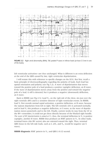 chapter 2: Morphologic Changes in P, QRS, ST, and T 39
FIGURE 2.2 Right atrial abnormality (RAA). Tall, peaked P waves in inferior leads (at least 2.5mm in one
of the leads).
left ventricular activation—are thus unchanged. What is different is an extra deflection
at the end of the QRS caused by late, right ventricular depolarization.
I will restate this with reference to specific changes on the ECG. But first, recall a
basic principle of electrocardiography regarding the polarity of leads. Each lead has
spatial orientation and polarity (see Fig 1.2). A wave of depolarization that moves
toward the positive pole of a lead produces a positive (upright) deflection, an R wave.
If the wave of depolarization moves away from the positive and toward the negative
pole of a lead, it still is detected, but it produces a negative (downward) deflection,
an S wave.
Back to RBBB (see Fig 2.3): Lead V1, on the right side of the chest, sits just over the
right ventricle (RV) and is a sensitive detector of right ventricular events. In RBBB,
lead V1 first records normal septal activation, a positive deflection, or R wave, because
the septum depolarizes from left to right. The left ventricle (LV) is activated normally,
and in lead V1 this produces a negative deflection, or S wave, as the wave of depolar-
ization moves posteriorly and to the left. Finally, current works its way from the LV to
the RV—remember, it could not get there directly because of the blocked right bundle.
The vector of RV depolarization is aimed at V1; thus, the terminal deflection in V1 is positive
(upright), another R wave. RBBB thus produces an RSR¢ pattern in V1. In other leads,
terminal forces (the RV vector) also are oriented toward the right. Thus, terminal
QRS forces in the left-side leads, such as I, aVL, and V6, would be negative (an S
wave).
RBBB diagnosis: RSR’ pattern in V1, and QRS ≥ 0.12 second.
 