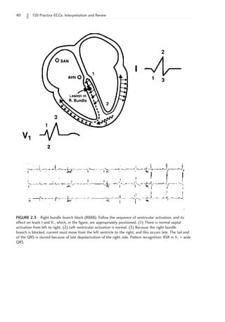 40 150 Practice ECGs: Interpretation and Review
FIGURE 2.3 Right bundle branch block (RBBB). Follow the sequence of ventricular activation, and its
effect on leads I and V1, which, in the figure, are appropriately positioned. (1) There is normal septal
activation from left to right. (2) Left ventricular activation is normal. (3) Because the right bundle
branch is blocked, current must move from the left ventricle to the right, and this occurs late. The tail end
of the QRS is slurred because of late depolarization of the right side. Pattern recognition: RSR in V1 + wide
QRS.
 