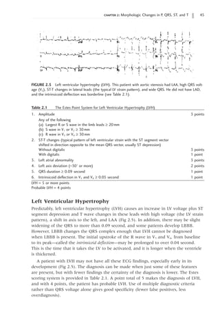 chapter 2: Morphologic Changes in P, QRS, ST, and T 45
FIGURE 2.5 Left ventricular hypertrophy (LVH). This patient with aortic stenosis had LAA, high QRS volt-
age (V2), ST-T changes in lateral leads (the typical LV strain pattern), and wide QRS. He did not have LAD,
and the intrinsicoid deflection was borderline (see Table 2.1).
Table 2.1   The Estes Point System for Left Ventricular Hypertrophy (LVH)
1. 
Amplitude 3 points
Any of the following
(a) Largest R or S wave in the limb leads ≥ 20mm
(b) S wave in V1 or V2 ≥ 30mm
(c) R wave in V5 or V6 ≥ 30mm
2. 
ST-T changes (typical pattern of left ventricular strain with the ST segment vector
shifted in direction opposite to the mean QRS vector, usually ST depression)
Without digitalis 3 points
With digitalis 1 point
3. 
Left atrial abnormality 3 points
4. 
Left axis deviation (-30° or more) 2 points
5. 
QRS duration ≥ 0.09 second 1 point
6. 
Intrinsicoid deflection in V5 and V6 ≥ 0.05 second 1 point
LVH = 5 or more points
Probable LVH = 4 points
Left Ventricular Hypertrophy
Predictably, left ventricular hypertrophy (LVH) causes an increase in LV voltage plus ST
segment depression and T wave changes in these leads with high voltage (the LV strain
pattern), a shift in axis to the left, and LAA (Fig 2.5). In addition, there may be slight
widening of the QRS to more than 0.09 second, and some patients develop LBBB.
However, LBBB changes the QRS complex enough that LVH cannot be diagnosed
when LBBB is present. The initial upstroke of the R wave in V5 and V6, from baseline
to its peak—called the intrinsicoid deflection—may be prolonged to over 0.04 second.
This is the time that it takes the LV to be activated, and it is longer when the ventricle
is thickened.
A patient with LVH may not have all these ECG findings, especially early in its
development (Fig 2.5). The diagnosis can be made when just some of these features
are present, but with fewer findings the certainty of the diagnosis is lower. The Estes
scoring system is provided in Table 2.1. A point total of 5 makes the diagnosis of LVH,
and with 4 points, the patient has probable LVH. Use of multiple diagnostic criteria
rather than QRS voltage alone gives good specificity (fewer false positives, less
overdiagnosis).
 