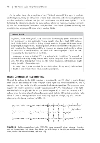 46 150 Practice ECGs: Interpretation and Review
On the other hand, the sensitivity of the ECG in detecting LVH is poor; it tends to
underdiagnose. Using an ECG point system, both anatomic and echocardiographic cor-
relation studies have shown that just half the cases of true LVH meet rigid ECG criteria.
Relaxing the diagnostic criteria, by using voltage alone for example, increases sensitiv-
ity but also increases the number of false positives. This choice between sensitivity and
specificity is a common dilemma when reading ECGs.
FIGURE 2.6 Right ventricular hypertrophy (RVH). This young woman with primary pulmonary hyperten-
sion had rightward axis, a tall R in V1, deep S in V6, and ST-T changes in the right precordial leads (the RV
strain pattern). She did not have RAA (see Table 2.2).
CLINICAL INSIGHT
In general, avoid overdiagnosis. Left ventricular hypertrophy (LVH) demonstrates
the importance of this principle. Young people often have high QRS voltage,
particularly if thin or athletic. Using voltage alone to diagnose LVH could mean
assigning that diagnosis to a healthy person. LVH is considered bad heart disease,
and carrying that diagnosis would be a problem for anyone applying for a job or
for insurance. It seems better to stick with strict ECG diagnostic criteria for LVH,
recognizing the insensitivity of the ECG.
A counter argument is that LVH is a serious heart condition. For example, a
person with coronary artery disease has a worse prognosis with the addition of
LVH. Any ECG finding that would lead to earlier diagnosis and treatment might
justify the risks of overdiagnosis.
In most cases, I place my vote for specificity (first, do no harm). When there
is doubt, it can be sorted out with an echocardiogram.
Right Ventricular Hypertrophy
Most of the voltage in the QRS complex is generated by the LV, which is much thicker
than the RV. This makes the QRS complex in the right-side precordial leads (V1 and V2)
negative, and that in the left-side precordial leads (V4–V6) positive. The transition from
negative to positive complexes usually occurs around V3–V4. That changes with right
ventricular hypertrophy (RVH). As you would expect, RVH causes an increase in RV
voltage over the right chest leads and an associated shift in QRS axis toward the right.
There is often a strain pattern in leads reflecting high RV voltage (Fig 2.6). Specific
diagnostic criteria are outlined in Table 2.2.
 
