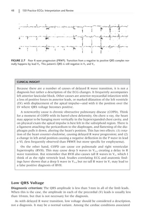 48 150 Practice ECGs: Interpretation and Review
Low QRS Voltage
Diagnostic criterion: The QRS amplitude is less than 5mm in all of the limb leads.
When this is the case, the amplitude in each of the precordial (V) leads is usually less
than 10mm, but that is not necessary for the diagnosis.
As with delayed R wave transition, low voltage should be considered a description,
not a diagnosis. It may be a normal variant. Among the cardiac conditions associated
FIGURE 2.7 Poor R wave progression (PRWP). Transition from a negative to positive QRS complex nor-
mally happens by lead V4. This patient’s QRS is still negative in V4 and V5.
CLINICAL INSIGHT
Because there are a number of causes of delayed R wave transition, it is not a
diagnosis but rather a description of the ECG changes. It frequently accompanies
left anterior fascicular block. Other causes are anterior myocardial infarction with
a loss of positive forces in anterior leads, or marked dilatation of the left ventricle
(LV) with displacement of the apical impulse—and with it the position over the
LV where QRS voltage becomes positive.
A noteworthy cause is chronic obstructive pulmonary disease (COPD). Think
for a moment of COPD with its barrel-chest deformity. On chest x-ray, the heart
may appear to be hanging more vertically in the hyperexpanded chest cavity, and
on physical exam the apical impulse is best felt in the subxiphoid region. There is
a ligament attaching the pericardium to the diaphragm, and flattening of the dia-
phragm pulls it down, altering the heart’s position. This has two effects: (1) rota-
tion of the heart counter-clockwise, causing delayed R wave progression; and (2)
a change in left atrial position causing a negative deflection in the P wave in lead
a VL (less frequently observed than PRWP, but more specific for emphysema).
On the other hand, COPD can cause cor pulmonale and right ventricular
hypertrophy (RVH). This may cause deep S waves in V5–6 creating a delay in R
wave transition. But remember that RVH also causes tall R waves in V1, which I
think of as the right ventricle lead. Studies correlating ECG and anatomic find-
ings have shown that a deep S wave in V5–6 but no tall R wave in V1 may lead to
a false positive diagnosis of RVH.
 