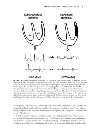 chapter 2: Morphologic Changes in P, QRS, ST, and T 51
FIGURE 2.9 Patterns of myocardial ischemia. The epicardium is the outside surface of the heart, and the
endocardium is the surface next to the ventricular cavity. The coronary arteries are located on the epicardial
surface. Subendocardial (nontransmural) ischemia causes ST segment depression. If ischemia persists and
there is myocardial injury, there may be T wave inversion (a pattern now called non-ST elevation MI, but
also referred to as subendocardial or nontransmural or non-Q wave infarction). Transmural ischemia is
caused by total occlusion of the artery. During acute ischemia, there is ST segment elevation. Resolution of
spasm or dissolution of thrombus may open the occluded artery before there is injury. In this case, the epi-
sode of ischemia represents angina pectoris. If occlusion and, therefore, ischemia persists and there is myo-
cardial injury, the pattern is called ST elevation MI (also referred to as transmural or Q wave infarction).
and negative forces are equal, canceling each other with a net sum of zero voltage. At
times it is difficult to identify the baseline. The segment just before the P wave is gen-
erally accepted as the baseline. Note that the PR segment or ST segment can shift up or
down with disease.
A shift in the ST segment from the baseline may indicate ischemia. ST depression
occurs with subendocardial ischemia (Fig 2.9). Cardiac catheterization during subendocar-
dial ischemia usually reveals that the coronary artery supplying the ischemic zone is
tightly stenosed but not (totally) occluded. There is a mismatch between blood supply
 