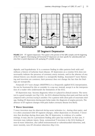 chapter 2: Morphologic Changes in P, QRS, ST, and T 53
digitalis, and hypokalemia. It is a common finding in older patients both with and
without a history of ischemic heart disease. ST depression on a routine ECG does not
necessarily indicate the presence of coronary artery stenosis, and in the absence of any
clinical history you should consider it a nonspecific finding. Associated T wave flatten-
ing and inversion are common; their presence does not change the fact that the find-
ings are nonspecific.
Nonspecific ST-T wave changes (NSSTTWCs) is a frequently applied ECG interpretation.
Do not be frustrated by this or consider it a cop-out; instead, accept it as the interpreta-
tion of a reader who understands the limitations of the ECG.
ST depression may become diagnostic when it is placed in clinical context. The stress
test is a good example (see Fig 2.10). An ECG obtained during chest pain and that can be
compared with a previous tracing is another. For a patient with chest pain of uncertain etiol-
ogy, finding ST depression during pain helps make the diagnosis of angina pectoris. The
absence of ST segment changes with pain makes coronary disease less likely.
T Wave Inversion
T wave inversion may be observed during acute ischemia (i.e., during chest pain), and
it is often associated with ST segment changes, either depression or elevation. T inver-
sion that develops during chest pain, like ST depression, is evidence of a cardiac
etiology. It may also be a permanent finding after pain has resolved. In that case, T
inversion may indicate injury. Deep, symmetrical T inversion is the ECG finding of
non–Q wave infarction, also called nontransmural or subendocardial infarction, and,
more recently, non–ST elevation infarction (Fig 2.12).
FIGURE 2.1
1 ST segment depression. The J point is the junction of the QRS complex and the beginning
of the ST segment. Downsloping and horizontal ST depression are more specific for subendocardial isch-
emia than is J point depression with upsloping ST’s (middle tracing).
 