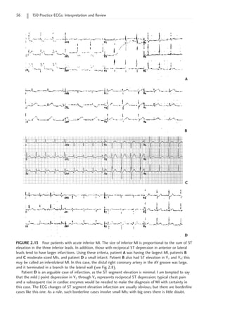 56 150 Practice ECGs: Interpretation and Review
FIGURE 2.13 Four patients with acute inferior MI. The size of inferior MI is proportional to the sum of ST
elevation in the three inferior leads. In addition, those with reciprocal ST depression in anterior or lateral
leads tend to have larger infarctions. Using these criteria, patient A was having the largest MI, patients B
and C moderate-sized MIs, and patient D a small infarct. Patient B also had ST elevation in V5 and V6; this
may be called an inferolateral MI. In this case, the distal right coronary artery in the AV groove was large,
and it terminated in a branch to the lateral wall (see Fig 2.8).
Patient D is an arguable case of infarction, as the ST segment elevation is minimal. I am tempted to say
that the mild J point depression in V2 through V4 represents reciprocal ST depression; typical chest pain
and a subsequent rise in cardiac enzymes would be needed to make the diagnosis of MI with certainty in
this case. The ECG changes of ST segment elevation infarction are usually obvious, but there are borderline
cases like this one. As a rule, such borderline cases involve small MIs; with big ones there is little doubt.
A
B
C
D
 