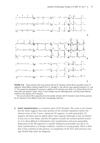 chapter 2: Morphologic Changes in P, QRS, ST, and T 57
FIGURE 2.14 Three patients with acute anterior MI and ST elevation. Patient A has upwardly convex ST
segments. Patient B has similarly shaped STs in V3 through V5, but still has some upward concavity in V1 and
V2. This patient has developed T inversion in addition to ST elevation (see Table 2.1). Patient C has ST ele-
vation plus tall, peaked T waves. These T wave changes may be called hyperacute, and they would indicate
ischemia in the absence of ST elevation.
The size of anterior MI is proportional to the number of leads with ST elevation. Each of these patients
has ST elevation in five different leads and is having large infarction.
A
B
C
2. Early repolarization is a common cause of ST elevation. The cause is not certain,
but the name suggests that some portion of the ventricle repolarizes before the
obvious onset of the T wave, raising the ST segment. As with pericarditis, ST
segment elevation may be global rather than regional (although it may be limited
to just one or two leads), and the ST segment usually has normal upward concav-
ity. It is often difficult to distinguish early repolarization and acute pericarditis.
Depression of the PR segment is a specific finding for pericarditis (see Fig 2.15).
Early repolarization is a benign condition, common in young people. There is little
day-to-day variation in this pattern, so comparison of the ECG with previous trac-
ings should help make the diagnosis.
 