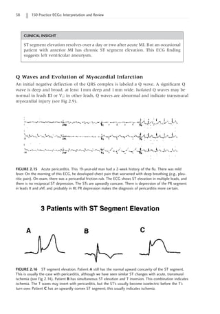 58 150 Practice ECGs: Interpretation and Review
FIGURE 2.15 Acute pericarditis. This 19-year-old man had a 2-week history of the flu. There was mild
fever. On the morning of this ECG, he developed chest pain that worsened with deep breathing (e.g., pleu-
ritic pain). On exam, there was a pericardial friction rub. The ECG shows ST elevation in multiple leads, and
there is no reciprocal ST depression. The STs are upwardly concave. There is depression of the PR segment
in leads II and aVF, and probably in III; PR depression makes the diagnosis of pericarditis more certain.
FIGURE 2.16 ST segment elevation. Patient A still has the normal upward concavity of the ST segment.
This is usually the case with pericarditis, although we have seen similar ST changes with acute, transmural
ischemia (see Fig 2.14). Patient B has simultaneous ST elevation and T inversion. This combination indicates
ischemia. The T waves may invert with pericarditis, but the ST’s usually become isoelectric before the T’s
turn over. Patient C has an upwardly convex ST segment; this usually indicates ischemia.
CLINICAL INSIGHT
ST segment elevation resolves over a day or two after acute MI. But an occasional
patient with anterior MI has chronic ST segment elevation. This ECG finding
suggests left ventricular aneurysm.
Q Waves and Evolution of Myocardial Infarction
An initial negative deflection of the QRS complex is labeled a Q wave. A significant Q
wave is deep and broad, at least 1mm deep and 1mm wide. Isolated Q waves may be
normal in leads III or V1; in other leads, Q waves are abnormal and indicate transmural
myocardial injury (see Fig 2.9).
 
