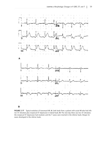 chapter 2: Morphologic Changes in P, QRS, ST, and T 59
FIGURE 2.17 Typical evolution of transmural MI. A: Limb leads from a patient with acute MI who had infe-
rior ST elevation plus reciprocal ST depression in lateral leads. B: The next day there was less ST elevation,
the reciprocal ST depression had resolved, and the T waves were inverted in the inferior leads. Deeper Q
waves developed in the inferior leads.
 