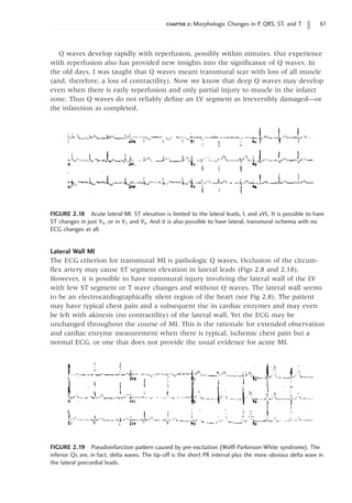 chapter 2: Morphologic Changes in P, QRS, ST, and T 61
FIGURE 2.18 Acute lateral MI. ST elevation is limited to the lateral leads, I, and aVL. It is possible to have
ST changes in just V6, or in V5 and V6. And it is also possible to have lateral, transmural ischemia with no
ECG changes at all.
Q waves develop rapidly with reperfusion, possibly within minutes. Our experience
with reperfusion also has provided new insights into the significance of Q waves. In
the old days, I was taught that Q waves meant transmural scar with loss of all muscle
(and, therefore, a loss of contractility). Now we know that deep Q waves may develop
even when there is early reperfusion and only partial injury to muscle in the infarct
zone. Thus Q waves do not reliably define an LV segment as irreversibly damaged—or
the infarction as completed.
FIGURE 2.19 Pseudoinfarction pattern caused by pre-excitation (Wolff-Parkinson-White syndrome). The
inferior Qs are, in fact, delta waves. The tip-off is the short PR interval plus the more obvious delta wave in
the lateral precordial leads.
Lateral Wall MI
The ECG criterion for transmural MI is pathologic Q waves. Occlusion of the circum-
flex artery may cause ST segment elevation in lateral leads (Figs 2.8 and 2.18).
However, it is possible to have transmural injury involving the lateral wall of the LV
with few ST segment or T wave changes and without Q waves. The lateral wall seems
to be an electrocardiographically silent region of the heart (see Fig 2.8). The patient
may have typical chest pain and a subsequent rise in cardiac enzymes and may even
be left with akinesis (no contractility) of the lateral wall. Yet the ECG may be
unchanged throughout the course of MI. This is the rationale for extended observation
and cardiac enzyme measurement when there is typical, ischemic chest pain but a
normal ECG, or one that does not provide the usual evidence for acute MI.
 