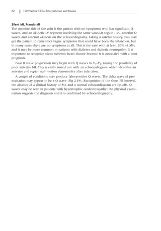 62 150 Practice ECGs: Interpretation and Review
Silent MI, Pseudo MI
The opposite side of the coin is the patient with no symptoms who has significant Q
waves, and an akinetic LV segment involving the same vascular region (i.e., anterior Q
waves and anterior akinesis on the echocardiogram). Taking a careful history, you may
get the patient to remember vague symptoms that could have been the infarction, but
in many cases there are no symptoms at all. This is the case with at least 20% of MIs,
and it may be more common in patients with diabetes and diabetic neuropathy. It is
important to recognize silent ischemic heart disease because it is associated with a poor
prognosis.
Poor R wave progression may begin with Q waves in V1–V2, raising the possibility of
prior anterior MI. This is easily sorted out with an echocardiogram which identifies an
anterior and septal wall motion abnormality after infarction.
A couple of conditions may produce false-positive Q waves. The delta wave of pre-
excitation may appear to be a Q wave (Fig 2.19). Recognition of the short PR interval,
the absence of a clinical history of MI, and a normal echocardiogram are tip-offs. Q
waves may be seen in patients with hypertrophic cardiomyopathy; the physical exami-
nation suggests the diagnosis and it is confirmed by echocardiography.
 