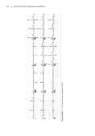 64 150 Practice ECGs: Interpretation and Review
Practice
ECG
1
A
57-year-old
man,
preoperative
ECG.
 