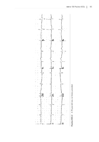 part ii: 150 Practice ECGs 65
Practice
ECG
2
A
78-year-old
man,
no
history
provided.
 