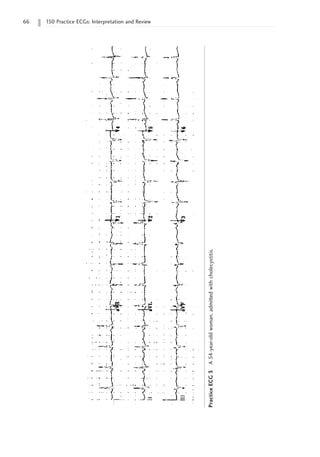 66 150 Practice ECGs: Interpretation and Review
Practice
ECG
3
A
54-year-old
woman,
admitted
with
cholecystitis.
 