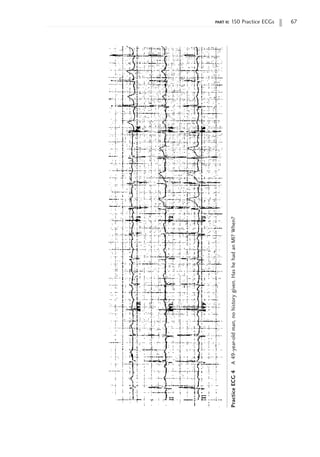 part ii: 150 Practice ECGs 67
Practice
ECG
4
A
49-year-old
man,
no
history
given.
Has
he
had
an
MI?
When?
 