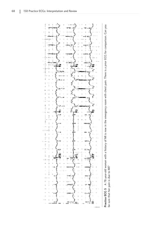 68 150 Practice ECGs: Interpretation and Review
Practice
ECG
5
A
78-year-old
woman
with
a
history
of
MI
is
now
in
the
emergency
room
with
chest
pain.
There
is
a
prior
ECG
for
comparison.
Can
you
be
sure
that
her
pain
is
due
to
MI?
 