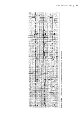 part ii: 150 Practice ECGs 69
Practice
ECG
6
A
36-year-old
man;
life
insurance
examination,
no
history
of
heart
disease.
 