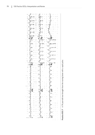 70 150 Practice ECGs: Interpretation and Review
Practice
ECG
7
A
79-year-old
man
brought
from
the
nursing
home
with
a
rapid
pulse.
 