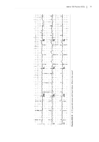 part ii: 150 Practice ECGs 71
Practice
ECG
8
A
72-year-old
woman
with
heart
failure.
What
is
the
cause?
 