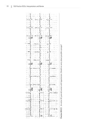 72 150 Practice ECGs: Interpretation and Review
Practice
ECG
9
An
active
82-year-old
woman
with
hypertension.
Should
we
worry
about
possible
syncope?
 