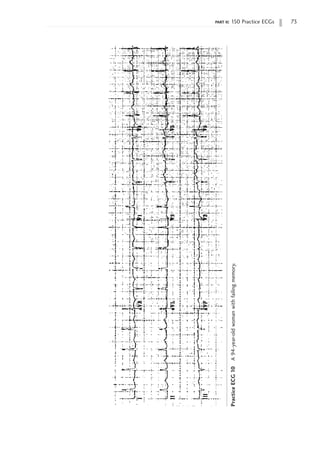 part ii: 150 Practice ECGs 73
Practice
ECG
10
A
94-year-old
woman
with
failing
memory.
 