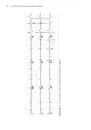 74 150 Practice ECGs: Interpretation and Review
Practice
ECG
1
1
A
72-year-old
man
with
a
long
history
of
heart
disease,
on
digoxin.
 