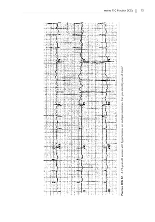 part ii: 150 Practice ECGs 75
Practice
ECG
12
A
73-year-old
woman
with
hypertension,
on
multiple
medicines.
Can
you
identify
one
of
them?
 