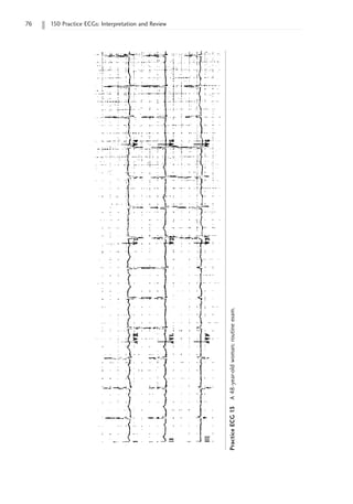 76 150 Practice ECGs: Interpretation and Review
Practice
ECG
13
A
48-year-old
woman;
routine
exam.
 