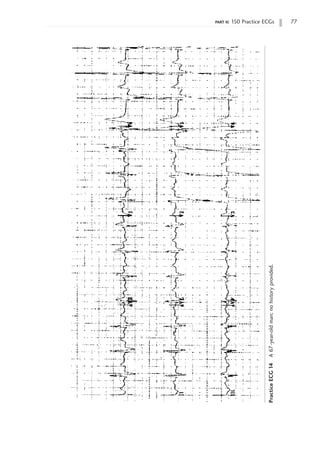 part ii: 150 Practice ECGs 77
Practice
ECG
14
A
67-year-old
man;
no
history
provided.
 