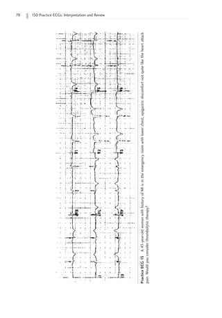 78 150 Practice ECGs: Interpretation and Review
Practice
ECG
15
A
43-year-old
woman
with
history
of
MI
is
in
the
emergency
room
with
lower
chest,
epigastric
discomfort
not
quite
like
the
heart
attack
pain.
Would
you
consider
thrombolytic
therapy?
 