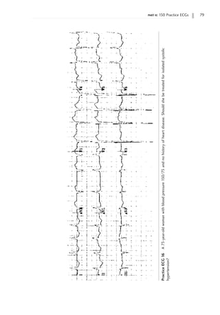 part ii: 150 Practice ECGs 79
Practice
ECG
16
A
73-year-old
woman
with
blood
pressure
150/75
and
no
history
of
heart
disease.
Should
she
be
treated
for
isolated
systolic
hypertension?
 