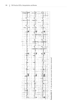 80 150 Practice ECGs: Interpretation and Review
Practice
ECG
17
A
46-year-old
man;
routine
exam.
Normal
or
abnormal?
 