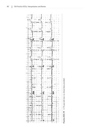 82 150 Practice ECGs: Interpretation and Review
Practice
ECG
19
A
74-year-old
man;
no
clinical
data
provided.
 