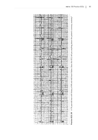 part ii: 150 Practice ECGs 83
Practice
ECG
20
A
76-year-old
man
with
history
of
MI
and
mild
heart
failure.
Does
this
ECG
tell
you
anything
about
the
patient’s
coronary
anatomy?
 
