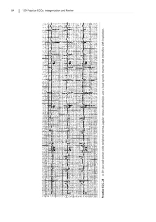 84 150 Practice ECGs: Interpretation and Review
Practice
ECG
21
A
59-year-old
woman
with
peripheral
edema,
jugular
venous
distension,
and
a
loud
systolic
murmur
that
intensifies
with
inspiration.
 