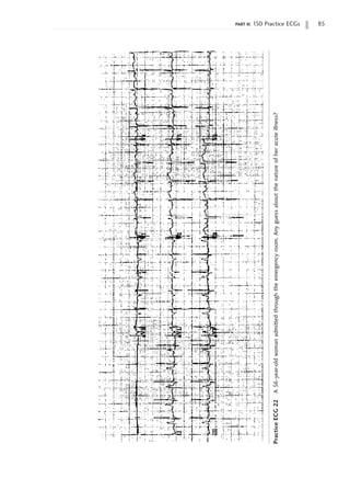 part ii: 150 Practice ECGs 85
Practice
ECG
22
A
56-year-old
woman
admitted
through
the
emergency
room.
Any
guess
about
the
nature
of
her
acute
illness?
 