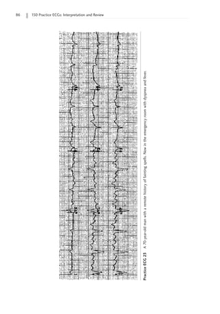 86 150 Practice ECGs: Interpretation and Review
Practice
ECG
23
A
70-year-old
man
with
a
remote
history
of
fainting
spells.
Now
in
the
emergency
room
with
dyspnea
and
fever.
 