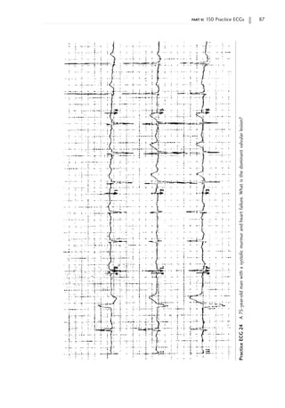 part ii: 150 Practice ECGs 87
Practice
ECG
24
A
75-year-old
man
with
a
systolic
murmur
and
heart
failure.
What
is
the
dominant
valvular
lesion?
 