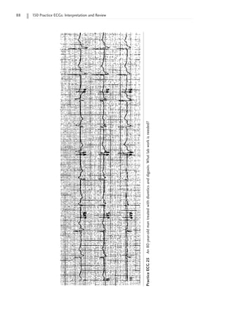 88 150 Practice ECGs: Interpretation and Review
Practice
ECG
25
An
80-year-old
man
treated
with
diuretics
and
digoxin.
What
lab
work
is
needed?
 
